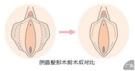 小阴唇肥大是怎么回事