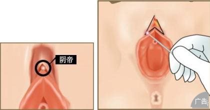 哪家医院在做阴蒂整形术好