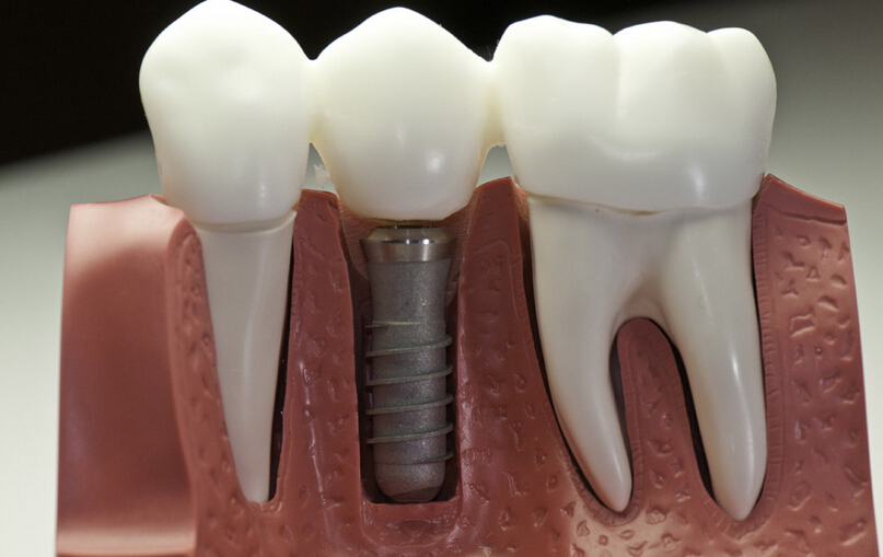 牙齿缺失修复的常用方法