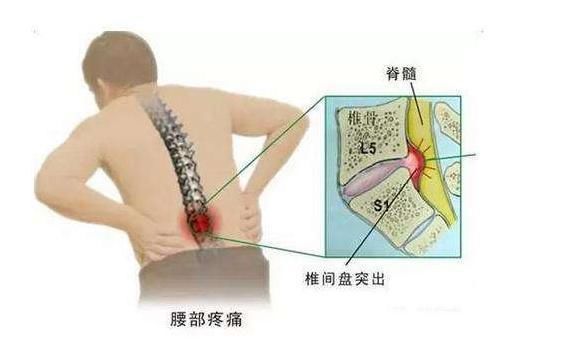 腰间盘突出有哪些检查项目